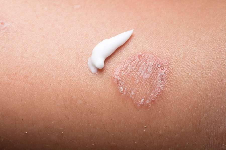 Facts-About-the-4-Most-Common-Fungal-Infections-and-How-to-Treat-Them