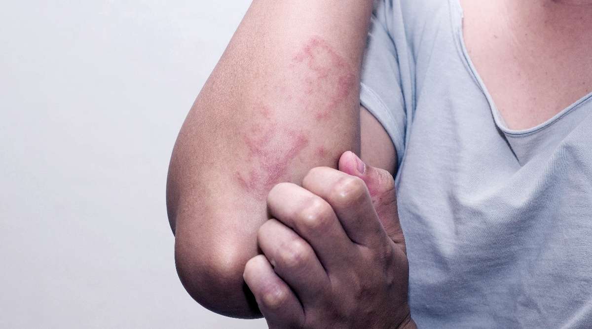Skin-Fungal-Infection-Laser-04